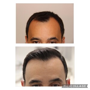 Image of Hair transplantation