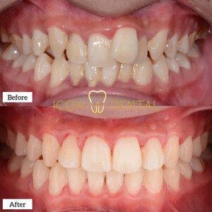 Image of Before and after dental treatment