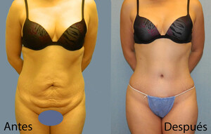 Image of Before and after body contouring