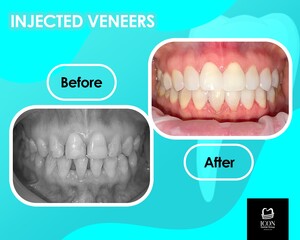 Image of Injected Veneers