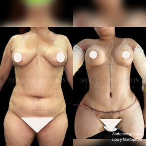 Image of Tummy tuck, liposuction and breast lift