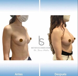 Image of Breast augmentation