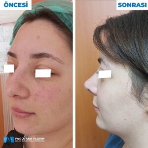 Image of Post operation rhinoplasty