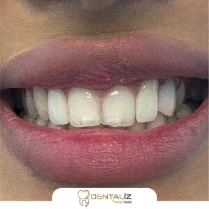 Image of teeth whitening