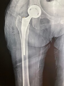 Image of Hip replacement