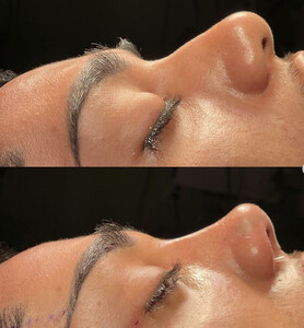 Image of Rhinoplasty