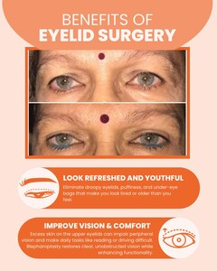 Image of Eyelid surgery before and after