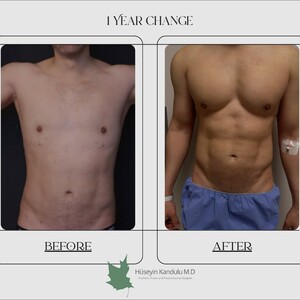 Image of Liposuction