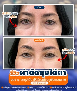 Image of Eyelid surgery