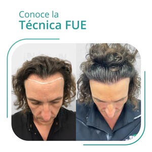 Image of FUE 