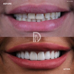 Image of Hollywood smile