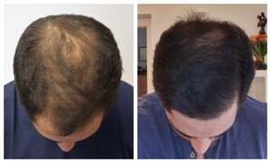 Image of FUE Hair transplant