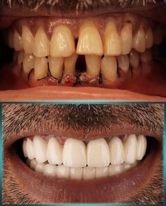 Image of Smile Makeover - Dr Popovic