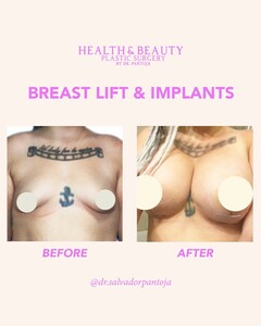 Image of Breast Lift and Implants