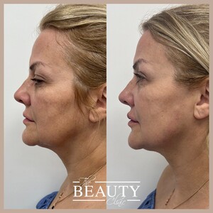 Image of Facelift - The Beauty clinic