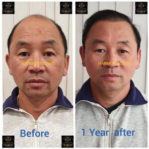 Image of Before and after hair transplant