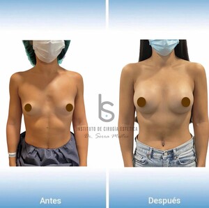 Image of Breast Implants