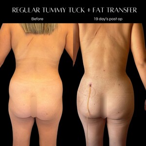 Image of Tummy tuck and fat transfer