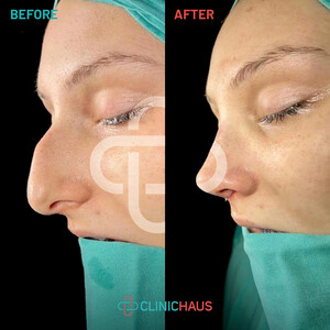 Image of Rhinoplasty