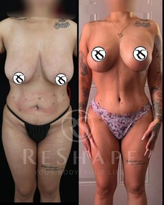 Image of Lipo Vaser 360, tummy tuck, and breast lift without implants