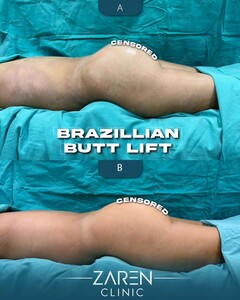 Image of Brazilian Butt Lift