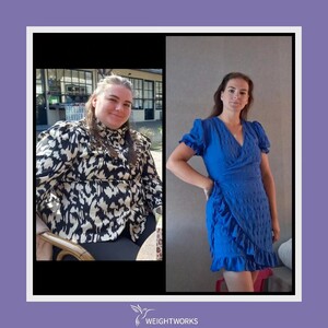 Image of Bariatric surgery before and after