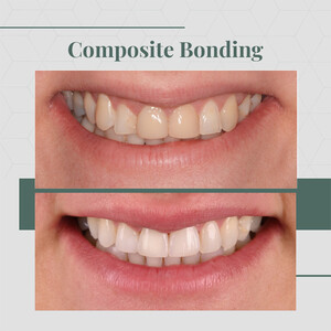 Image of Composite bonding