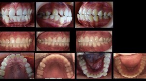 Image of Braces