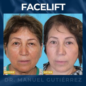 Image of Facelift