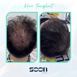 Image of Hair transplant results