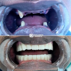 Image of Dental implants