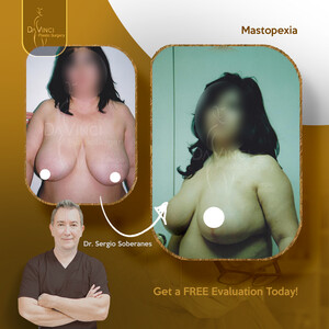 Image of Breast reduction