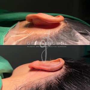 Image of Otoplasty- Dr Gera Tagani