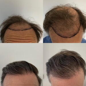 Image of Harris Hair Transplant UK Gallery 0