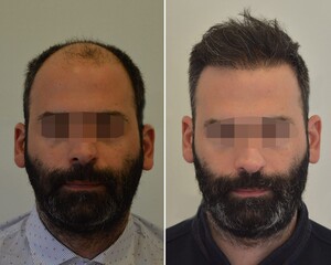 Image of Seneca Hair Transplant Gallery 3