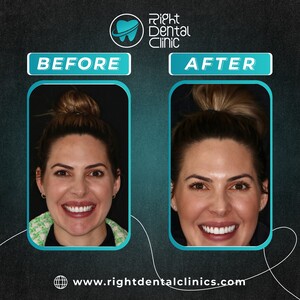 Image of Dental treatment before and after