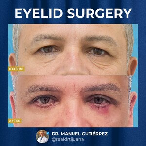 Image of Eyelid surgery