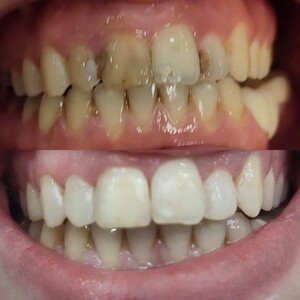 Image of Composite bonding - Selin Dental Clinic