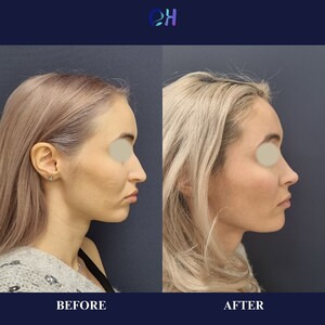 Image of Rhinoplasty - Dr. Olimpiu Harceaga