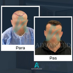 Image of Advanced Hair Transplant Gallery 0