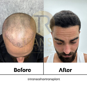 Image of Transes Hair Transplant Gallery 0