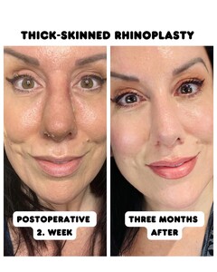 Image of Thick-skinned rhinoplasty