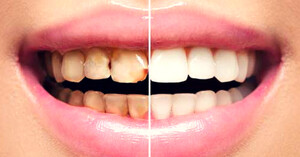 Image of Teeth whitening