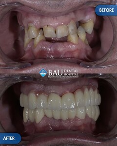 Image of Dental implants