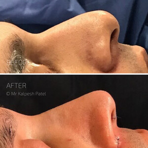 Image of London Rhinoplasty Gallery 1