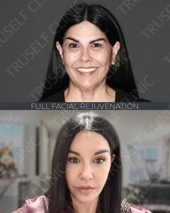 Image of Full Facial Rejuvenation