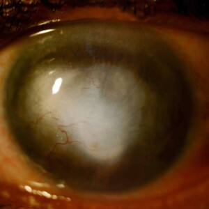 Image of Corneal Transplantation BEFORE