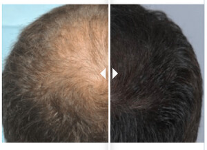 Image of Hair Transplantation Before and After