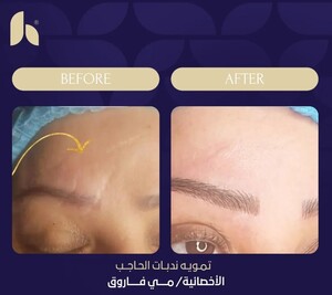 Image of Eyebrow transplantation - Al Hokail Medical Center