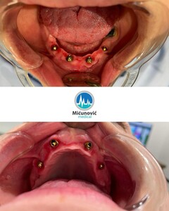 Image of Dental implants - Micunovic medical